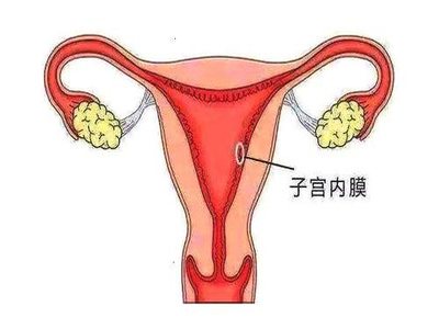 兴义妇女子宫内膜炎是否影响受孕